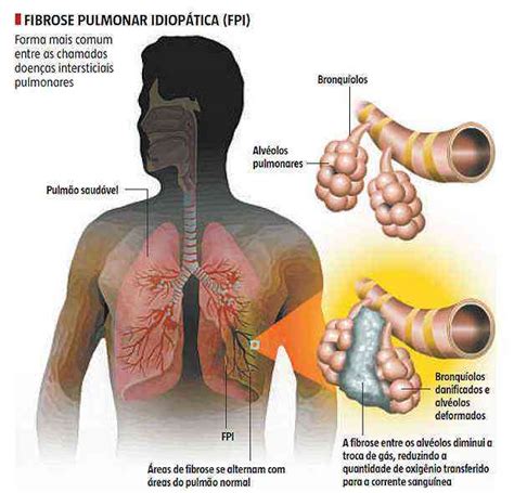 o que é fibrose pulmonar
